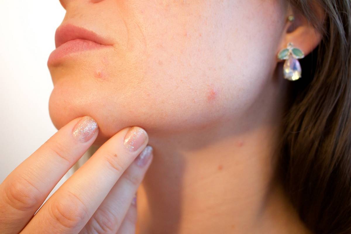 Como acalmar pele irritada: Veja métodos
